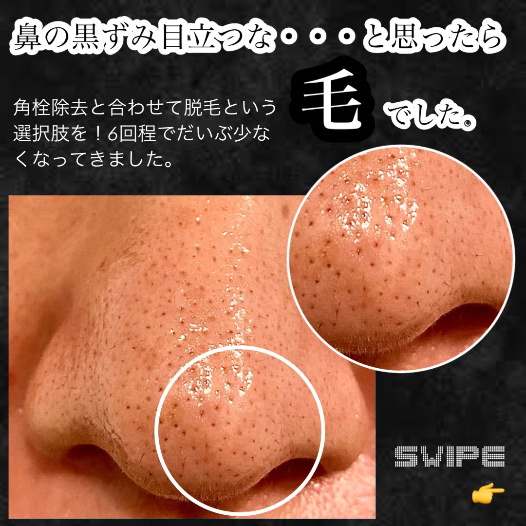 tk_hadakaizen's tweet photo. 鼻の黒ずみは手強い。
脱毛重ねて、ソフィーナupのポアクリアリングジェルウォッシュでも中々キレイにならない。美容医療に手を出すか🤔
#鼻脱毛 #鼻の黒ずみ https://t.co/OkgIsUpA8z