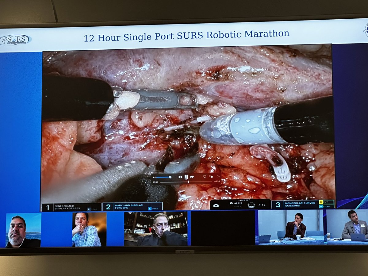 Soroush Rais-Bahrami, MD, MBA, FACS (@raisbahrami) on Twitter photo Starting <a href="/SocietySURS/">Society of Urologic Robotic Surgeons (SURS)</a> 12hr SP Robotic Marathon 1st case with <a href="/UABUroOnc/">Jeff Nix</a> and <a href="/afang5604/">Andrew Fang</a> SP partial nephrectomy with expert discussants <a href="/NYCRoboticTeam/">Ketan K. Badani MD</a> <a href="/Drkavoussi/">Louis Kavoussi</a> <a href="/alexanderchowmd/">Alex Chow, MD</a> & AngeloBaccala Starting <a href="/SocietySURS/">Society of Urologic Robotic Surgeons (SURS)</a> 12hr SP Robotic Marathon 1st case with <a href="/UABUroOnc/">Jeff Nix</a> and <a href="/afang5604/">Andrew Fang</a> SP partial nephrectomy with expert discussants <a href="/NYCRoboticTeam/">Ketan K. Badani MD</a> <a href="/Drkavoussi/">Louis Kavoussi</a> <a href="/alexanderchowmd/">Alex Chow, MD</a> & AngeloBaccala