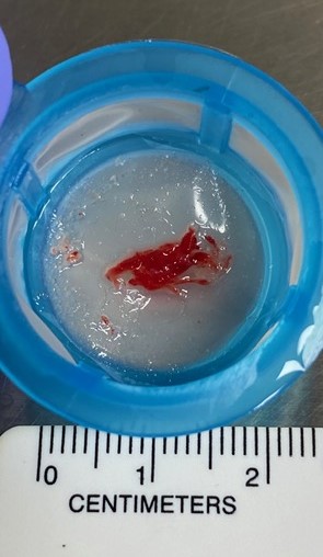 BSCCardiology's tweet photo. Stroke during TAVR happens, and every #TAVR patient deserves protection. This #WorldStrokeDay learn more about the reality of TAVR-related #stroke and SENTINEL™ Cerebral Embolic Protection: https://t.co/PwsV8IvYae 

#PROTECTEDTAVR
Safety info: https://t.co/B9ehbjyUBm https://t.co/iV9KLUN1q7
