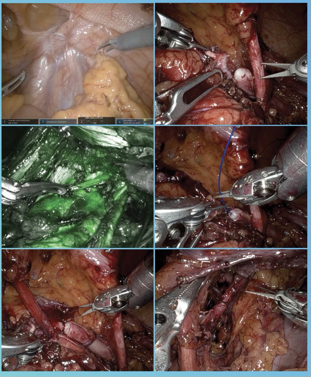 Neel Parekh (@neelparekhmd) on Twitter photo Robotic transabdominal vasectomy reversal is an option for those who underwent concomitant vasectomy at time of lap hernia repair. In our series of 3, mean concentration of 62 million sperm/mL! #smsna22 🦾💦<a href="/ScottLundyMDPhD/">Scott Lundy MD PhD HCLD</a> <a href="/CMikesellMD/">Carter Mikesell MD</a> <a href="/AskDoctorJay/">Jayram Krishnan DO MBA | Urologist</a> <a href="/drjkaouk/">Dr. J. Kaouk</a> <a href="/CleClinicUro/">Cleveland Clinic Urology</a> Robotic transabdominal vasectomy reversal is an option for those who underwent concomitant vasectomy at time of lap hernia repair. In our series of 3, mean concentration of 62 million sperm/mL! #smsna22 🦾💦<a href="/ScottLundyMDPhD/">Scott Lundy MD PhD HCLD</a> <a href="/CMikesellMD/">Carter Mikesell MD</a> <a href="/AskDoctorJay/">Jayram Krishnan DO MBA | Urologist</a> <a href="/drjkaouk/">Dr. J. Kaouk</a> <a href="/CleClinicUro/">Cleveland Clinic Urology</a>