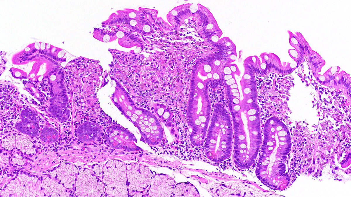 Vik_deshpandeMD's tweet photo. Oh dear! Oh dear! I should have known this! #GIpath Duodenal  biopsy. That third stain is PAS/D https://t.co/FMpAFui5Xf