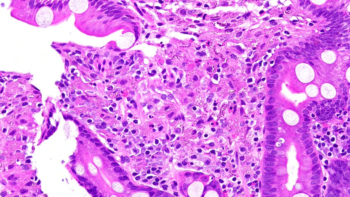 Vik_deshpandeMD's tweet photo. Oh dear! Oh dear! I should have known this! #GIpath Duodenal  biopsy. That third stain is PAS/D https://t.co/FMpAFui5Xf