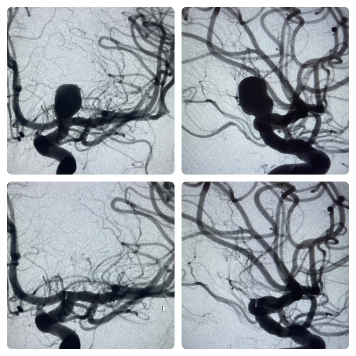 Outpatient endovascular aneurysm treatment <a href="/WashUNeurosurg/">WashU Med Taylor Family Department of Neurosurgery</a> 
44/F with unruptured ICA terminus aneurysm. Discharged home 6 hours after embo with WEB. Amazing what we can do for our patients in 2022!
<a href="/cvsection/">CV Section</a> <a href="/SNISinfo/">SNIS Info</a> #Neurosurgery