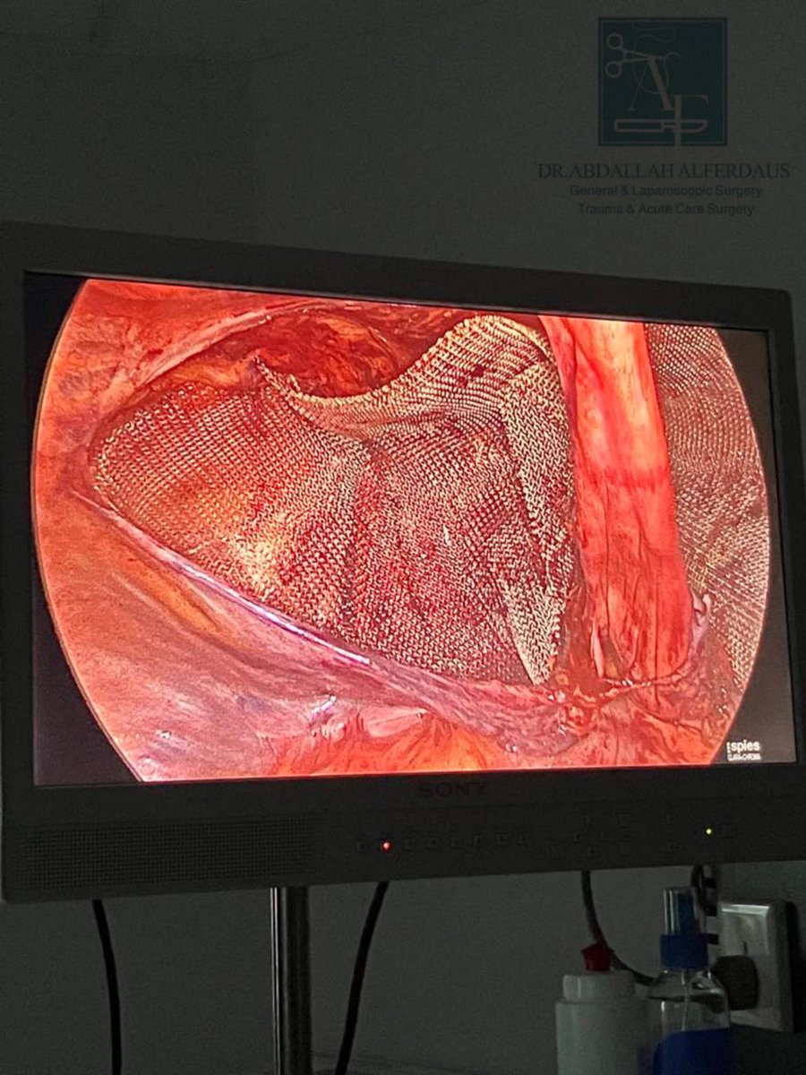 عملية إصلاح فتق إربي في الجهتين عن طريق المنظار

Bilateral TAPP Inguinal Hernioplasty