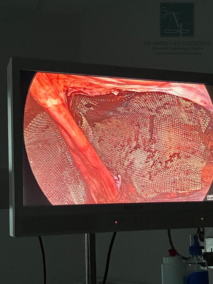 dr_abdallahdaus's tweet photo. عملية إصلاح فتق إربي في الجهتين عن طريق المنظار

Bilateral TAPP Inguinal Hernioplasty https://t.co/99DqjHxXPn
