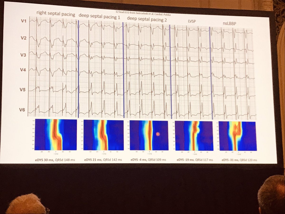 Outstanding presentation by @curilakarol ultrahigh freq ECG during screwing. Hard work in Prague 😍

20 hours of flight were worth it for this amazing #PPS6 😊