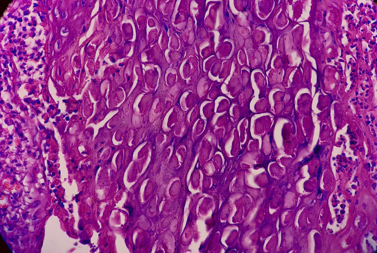 ArezuRhn (@arezurhn) on Twitter photo A 34-year-old woman with genital skin lesion
Dx: Molluscum Contagiosum
Henderson-Patterson bodies
#Pathology😍 
#Tums #PathTwitter A 34-year-old woman with genital skin lesion
Dx: Molluscum Contagiosum
Henderson-Patterson bodies
#Pathology😍 
#Tums #PathTwitter