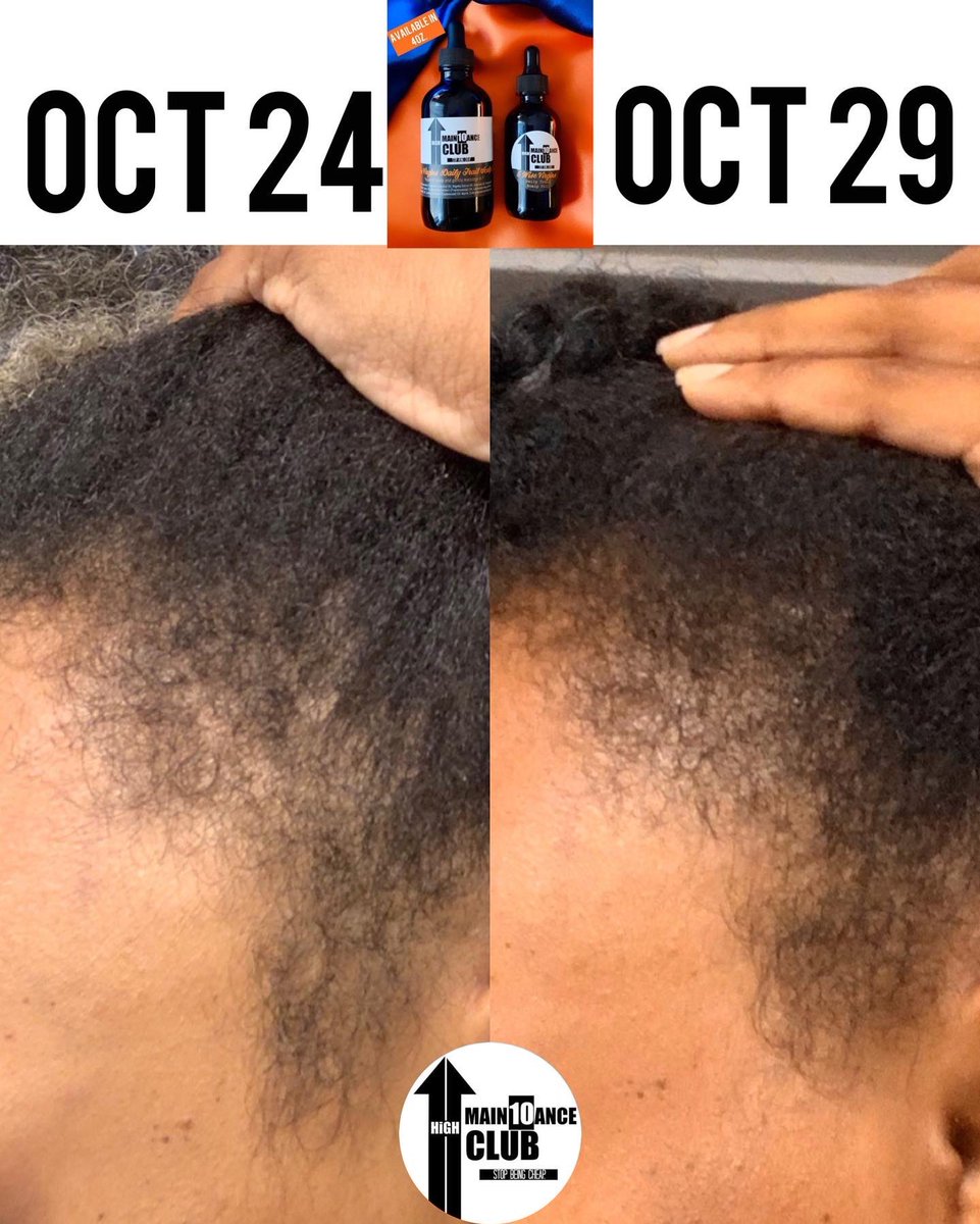 10alishaisrael's tweet image. 5 days with 5 Wise Virgins Daily Trail Oil! 🔥🌱💙 Results Only.🙏🏾🔥 #StayReady 🕯 
highmain10anceclub.com

#HighMain10anceClub #StopBeingCheap
#hairgrowth #hair #haircare #naturalhair #healthyhair #hairgoals #hairloss #hairstyles #beauty #curlyhair #Edges #hairtransformation