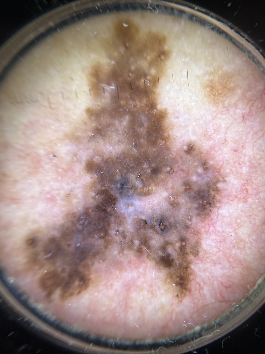 dermacrehuet's tweet photo. 60 year-old man with this pigmented lesion on his back. What do you think?diagnosis? Dermoscopic features? #dermatology ⁦@aedv_es⁩ #cordobaesp #skin #saturday #dermoscopy #dermatologist https://t.co/p1bnefzq5m