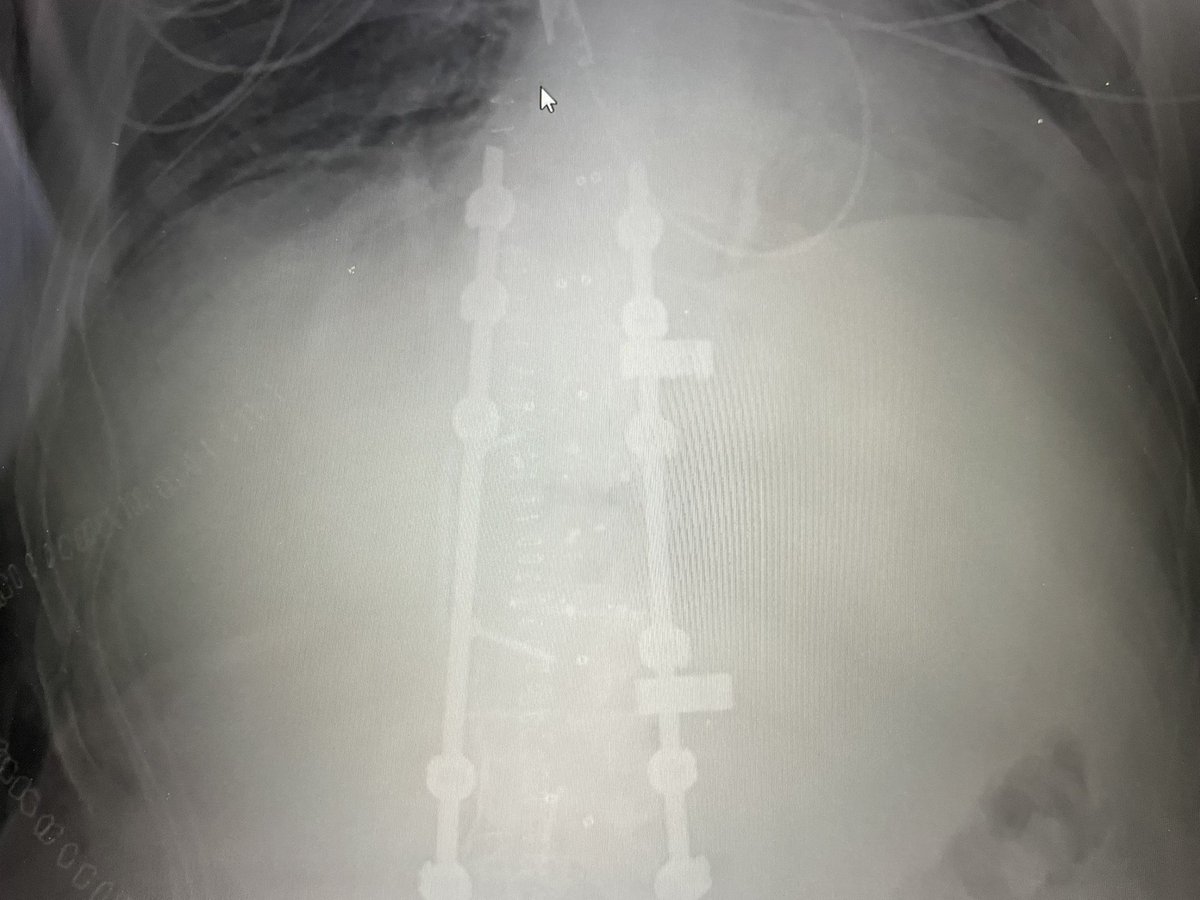 rjmehran's tweet photo. 3-D printed model of a chordoma of L1. 3-D printed technology is a useful tool in planning these complex multidisciplinary cases, here lead by Dr. Larry Rhines. https://t.co/GAbwC146IL