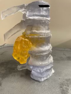 rjmehran's tweet photo. 3-D printed model of a chordoma of L1. 3-D printed technology is a useful tool in planning these complex multidisciplinary cases, here lead by Dr. Larry Rhines. https://t.co/GAbwC146IL