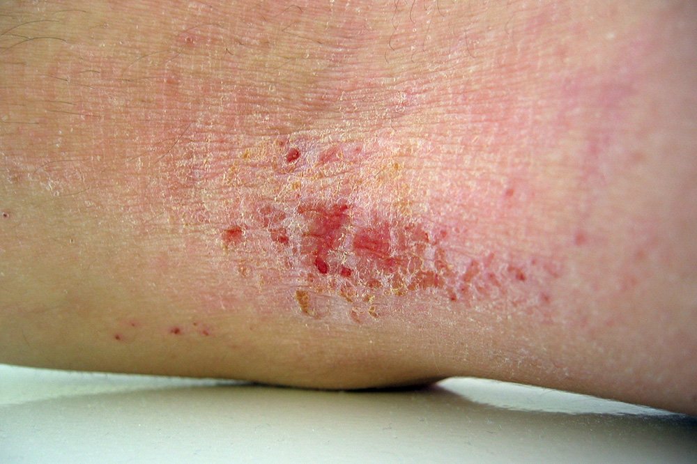 MedTweetMYHQ's tweet photo. MANA SATU ECZEMA ANDA? (PART 1)

Hello orang ramai!

Ramai orang tidak tahu eczema ada pelbagai jenis, bentuk &amp; rupa. Kebanyakannya fikir eczema hanya berlaku pada bayi atau kanak-kanak saja. Jom belajar lebih lanjut jom!

Threads! https://t.co/Wnlp1SJoul