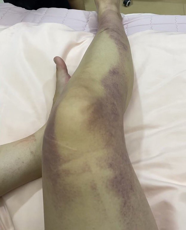 Top_Disaster's tweet photo. Horrible- This is a picture of survivors of #ItaewonStampede, with bruises all over the body and difficulty breathing. 

#ItaewonStampede #SouthKorea #Halloween  #Seoul  #CardiacArrest #Itaewon #대한민국 #할로윈 #서울
#이태원 https://t.co/pxBPEqFQtF