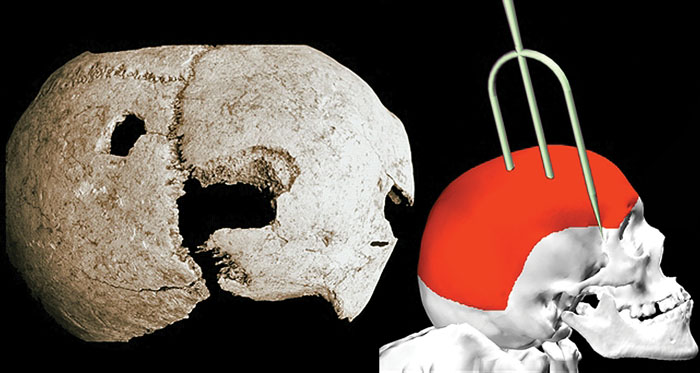 OptimoPrincipi's tweet image. Skull from the gladiator graveyard of Ephesus. Analysis of the injuries shows the man&apos;s head was impaled from above by a trident. The strike was likely delivered execution-style to the kneeling gladiator, after he had lost a bout and proven unsuccessful in any appeal for mercy.