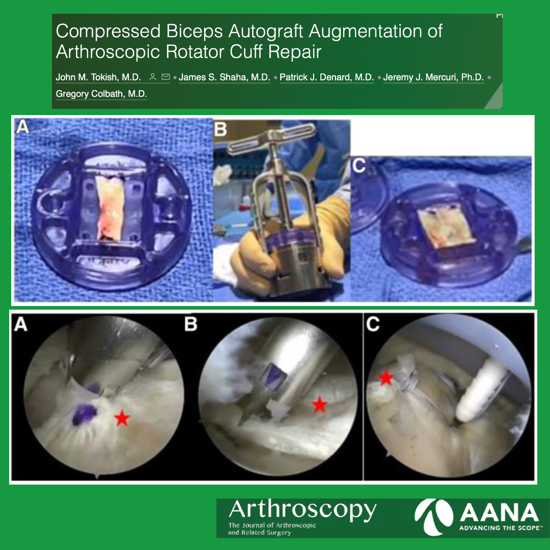 Arthroscopy Journal (@arthroscopyj) on Twitter photo Waste not, want not.
Wasting the biceps stump after tenodesis? Consider using it to augment your cuff repair instead <a href="/patrickdenardMD/">Patrick Denard, M.D</a> and JT Tokish ow.ly/OULC50LixGu Waste not, want not.
Wasting the biceps stump after tenodesis? Consider using it to augment your cuff repair instead <a href="/patrickdenardMD/">Patrick Denard, M.D</a> and JT Tokish ow.ly/OULC50LixGu