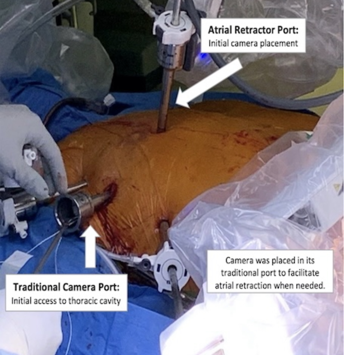 Here is our report of the least invasive mitral valve surgery ever performed - “A New Frontier: No Working Port For Robotic Mitral Valve Repair” meetings.ismics.org/program/2022/P…