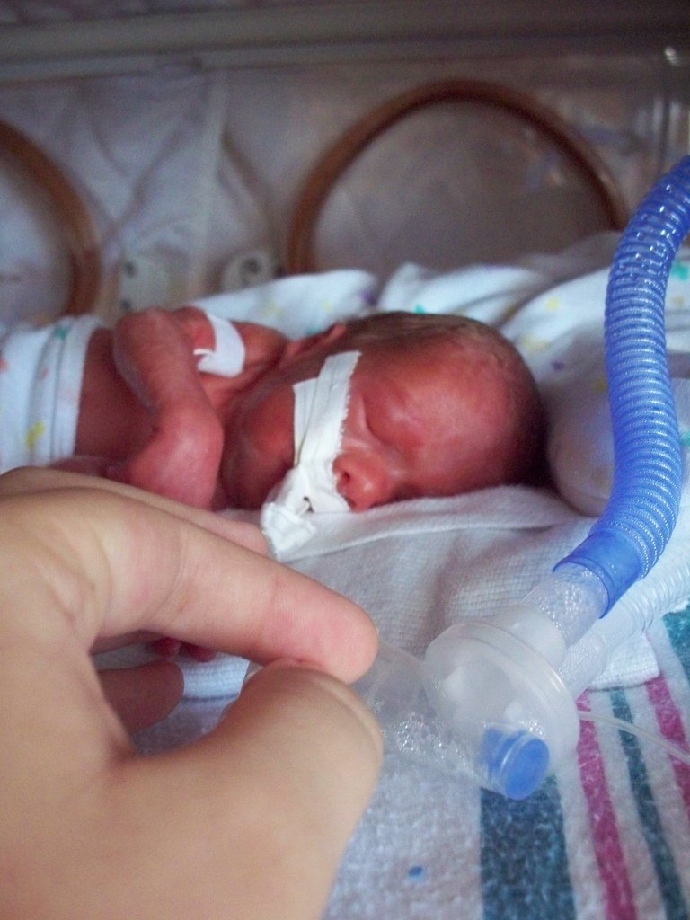 NICU_Musings's tweet photo. Much like ibuprofen, it appears paracetamol may have higher efficacy at closing a PDA when used as 1st line treatment when given by the oral (70%) vs IV (40%) route regardless of GA
#neoTwitter 
https://t.co/YcDx381v4l https://t.co/Asqy0yYfNP