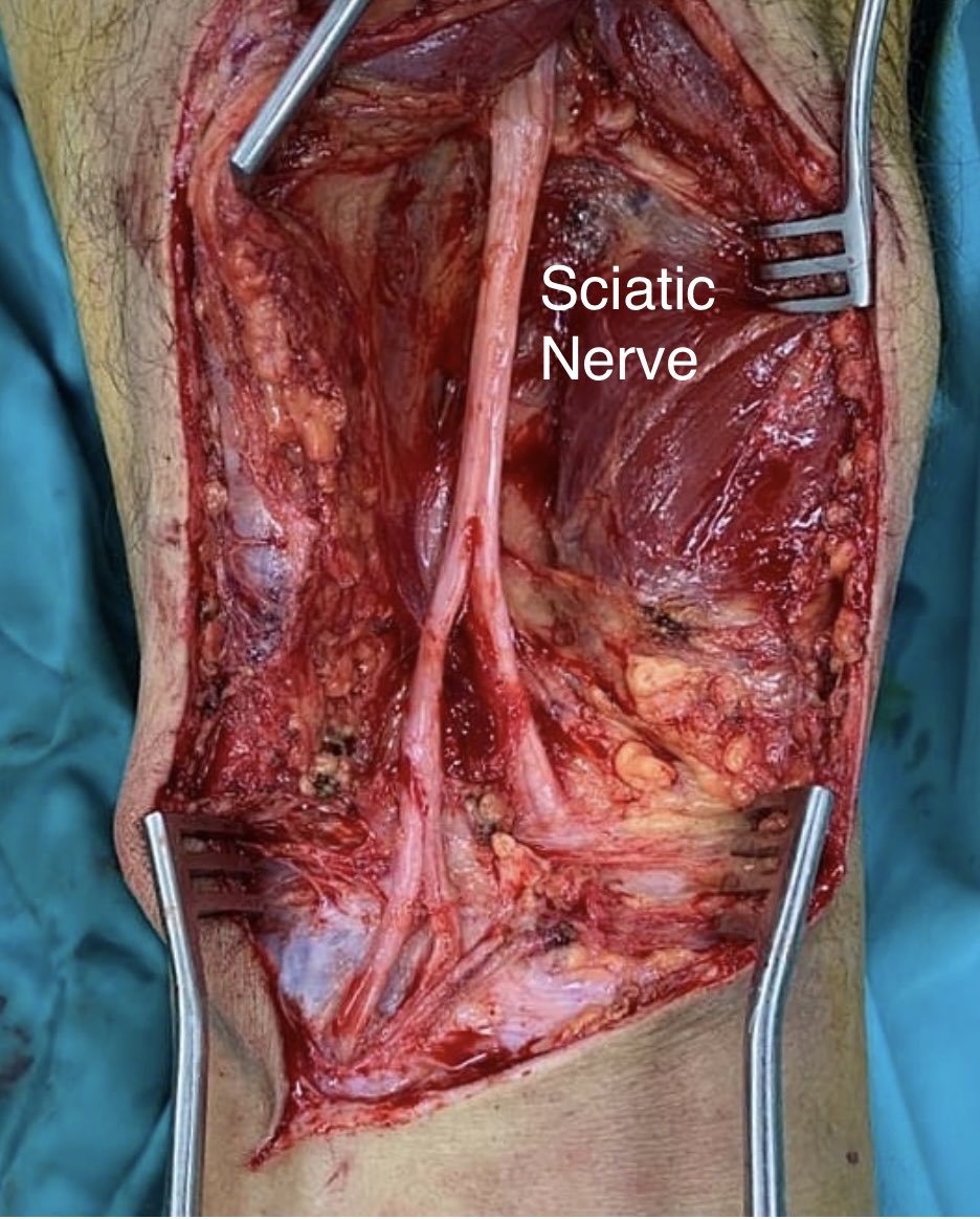 OGdukeneurosurg's tweet photo. Great Operative exposure of #Sciatic nerve bifurcating into tibial and common peroneal. #neurosurgery #orthotwitter #neurotwitter https://t.co/W9ViuOsIE6