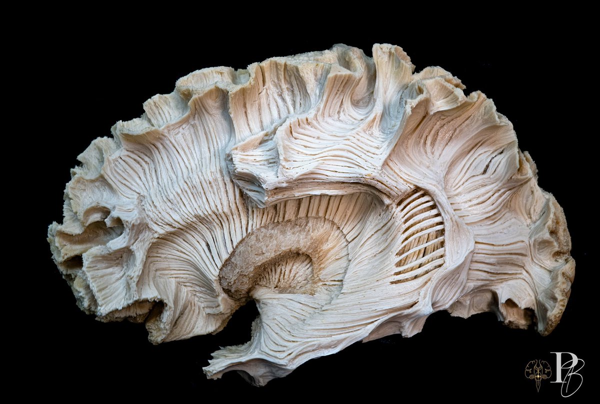 Daniel “Photobrain” Ballesteros (@photobrain_mx) on Twitter photo An incredible dissection by @anato_mind where you can appreciate perfectly some white matter tracts. Photography by <a href="/photobrain_mx/">Daniel “Photobrain” Ballesteros</a>. Always a pleasure to collaborate with great anatomists from the globe. Thanks @lanemiccat2 #neurosurgery #glioma #brain #whitefibers #neurotwitter An incredible dissection by @anato_mind where you can appreciate perfectly some white matter tracts. Photography by <a href="/photobrain_mx/">Daniel “Photobrain” Ballesteros</a>. Always a pleasure to collaborate with great anatomists from the globe. Thanks @lanemiccat2 #neurosurgery #glioma #brain #whitefibers #neurotwitter
