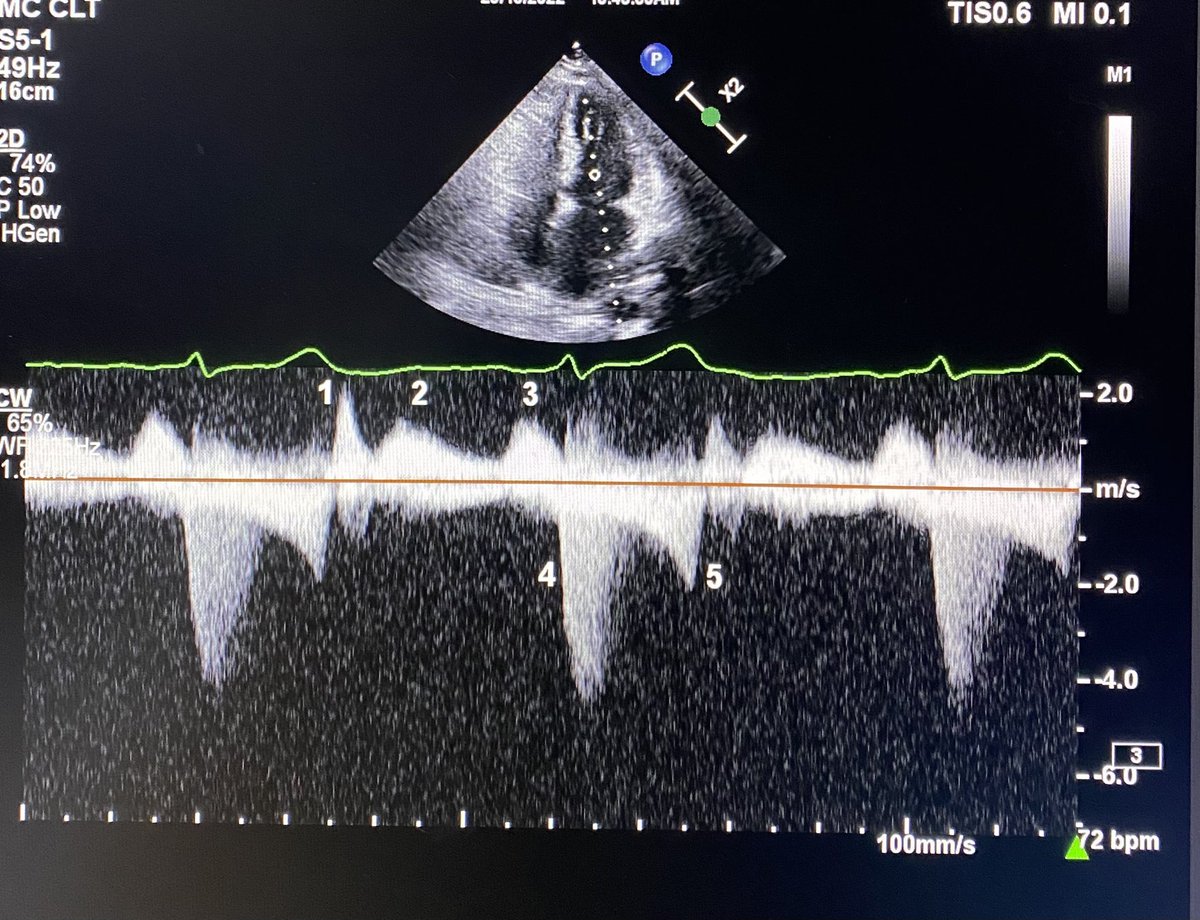 Fellows please. Doppler finding?