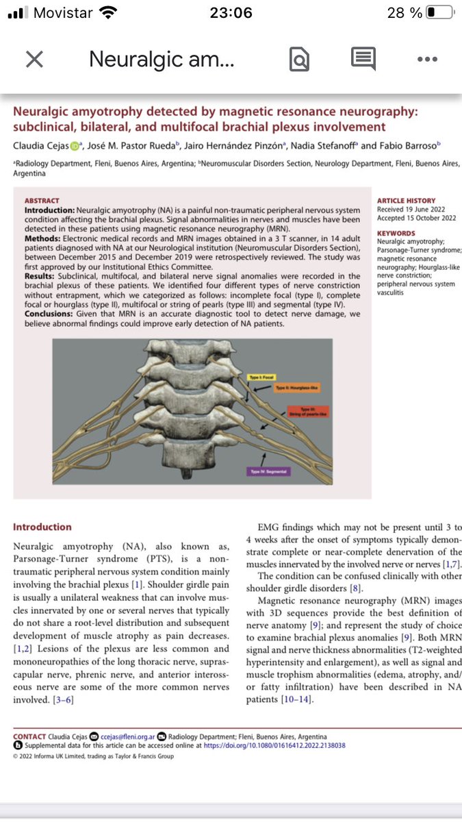 La neuralgia amiotrofica (NA) o sindrome de Parsonage Turner es una entidad subdiagnosticada. La Neurografia por RM es una técnica prometedora como apoyo diagnóstico a la evaluación clínica y electro fisiológica.