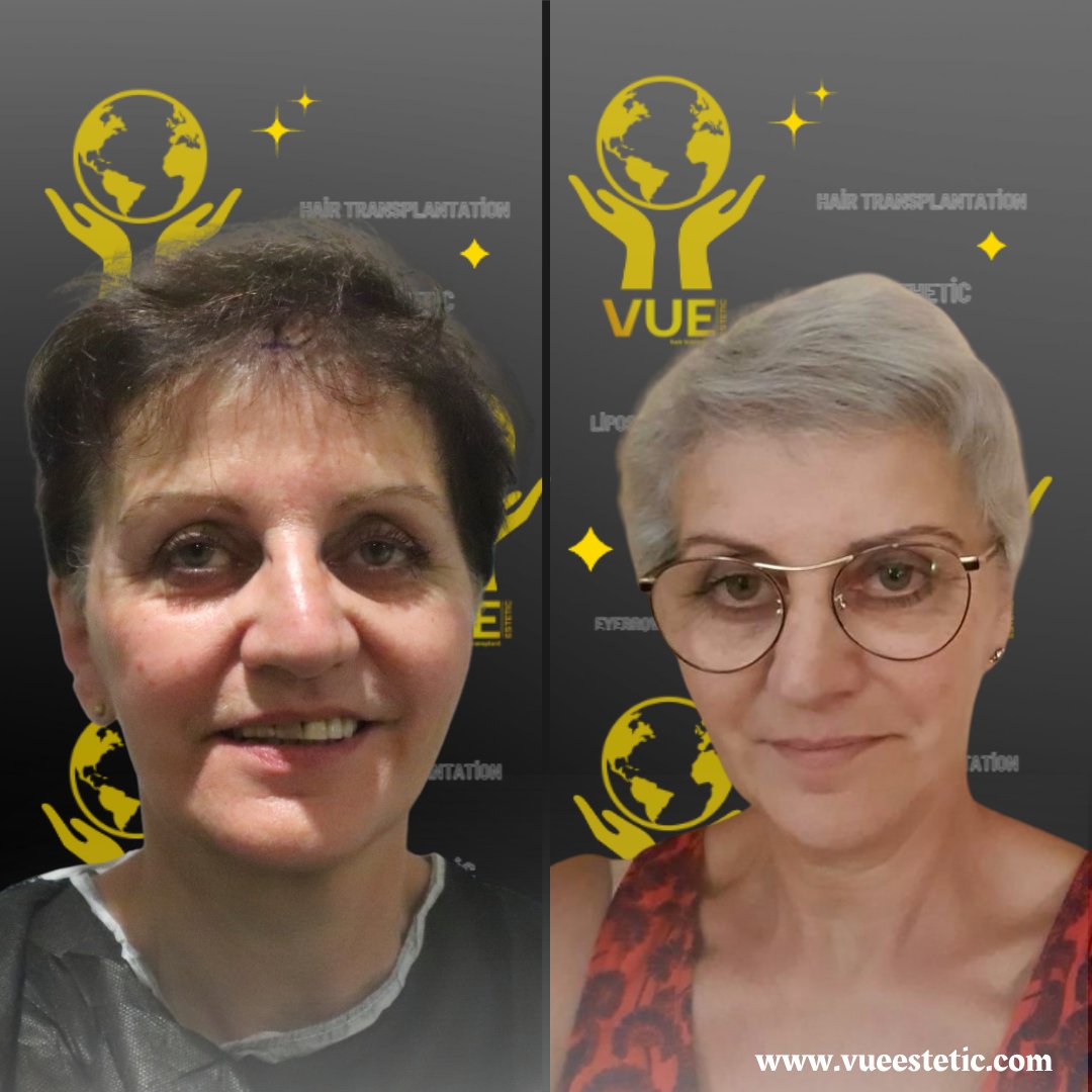 VUE Estetic (@vueestetic) on Twitter photo Fransa'dan gelen hastamızın 5'nci ayında Saç Ekim işlem sonucu.
.
.
🇹🇷
Firmamız olarak size, son teknoloji ürünler ile cerrahi işlemleri yapmaktayız. VUE Estetic deneyimiyle tanışın.
İLETİŞİM:
GSM: +90 544 636 42 47
Mail: info@vueestetic.com
WEB: vueestetic.com Fransa'dan gelen hastamızın 5'nci ayında Saç Ekim işlem sonucu.
.
.
🇹🇷
Firmamız olarak size, son teknoloji ürünler ile cerrahi işlemleri yapmaktayız. VUE Estetic deneyimiyle tanışın.
İLETİŞİM:
GSM: +90 544 636 42 47
Mail: info@vueestetic.com
WEB: vueestetic.com