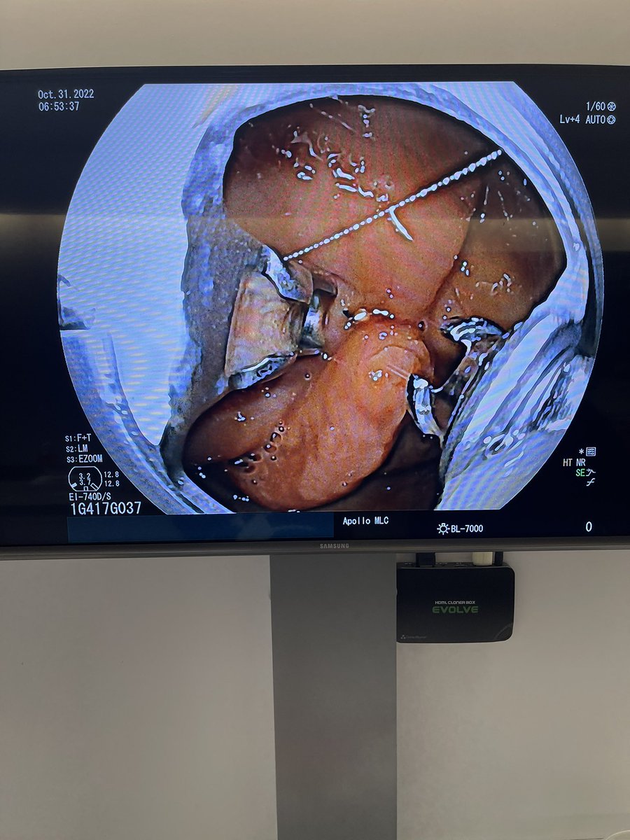 NumanLaith's tweet photo. What a great start to the week with endoscopic #suturing using #OverStitch and #XTack by @APOLLO_ENDO. #GITwitter #AdvancedEndoscopy #MedEd #MedTwitter https://t.co/o2WHKIql6w