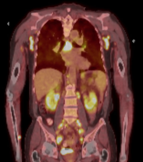 Annals of Internal Medicine: Clinical Cases (@annalsofimcc) on Twitter photo Rosai-Dorfman Disease Presenting as Massive Mediastinal Lymphadenopathy in an Elderly Man. Full text of this case report from <a href="/HopkinsMedicine/">Johns Hopkins Medicine</a> freely available at ow.ly/SZA750LpFa5. <a href="/ACPinternists/">ACP</a> <a href="/AHAScience/">AHA Science</a> #AHAjournals Rosai-Dorfman Disease Presenting as Massive Mediastinal Lymphadenopathy in an Elderly Man. Full text of this case report from <a href="/HopkinsMedicine/">Johns Hopkins Medicine</a> freely available at ow.ly/SZA750LpFa5. <a href="/ACPinternists/">ACP</a> <a href="/AHAScience/">AHA Science</a> #AHAjournals
