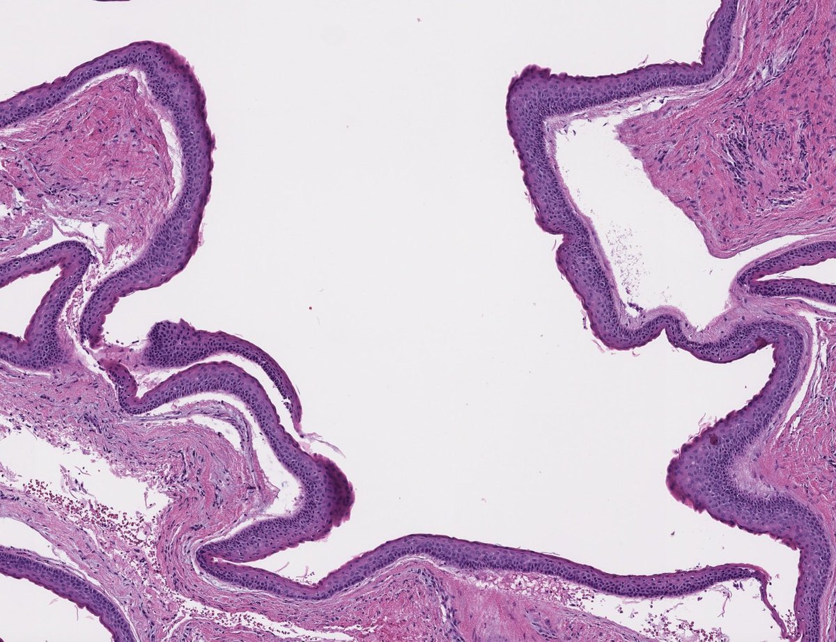 ihartpathology's tweet photo. Patient presents with an asymptomatic, lytic lesion found incidentally on x-ray. Diagnosis? This entity arises from the loss of which gene? Can you name an associated syndrome? Answer and pearls in the comments! #PathTwitter #MedEd #ENTpath https://t.co/DyHbMGJAjR
