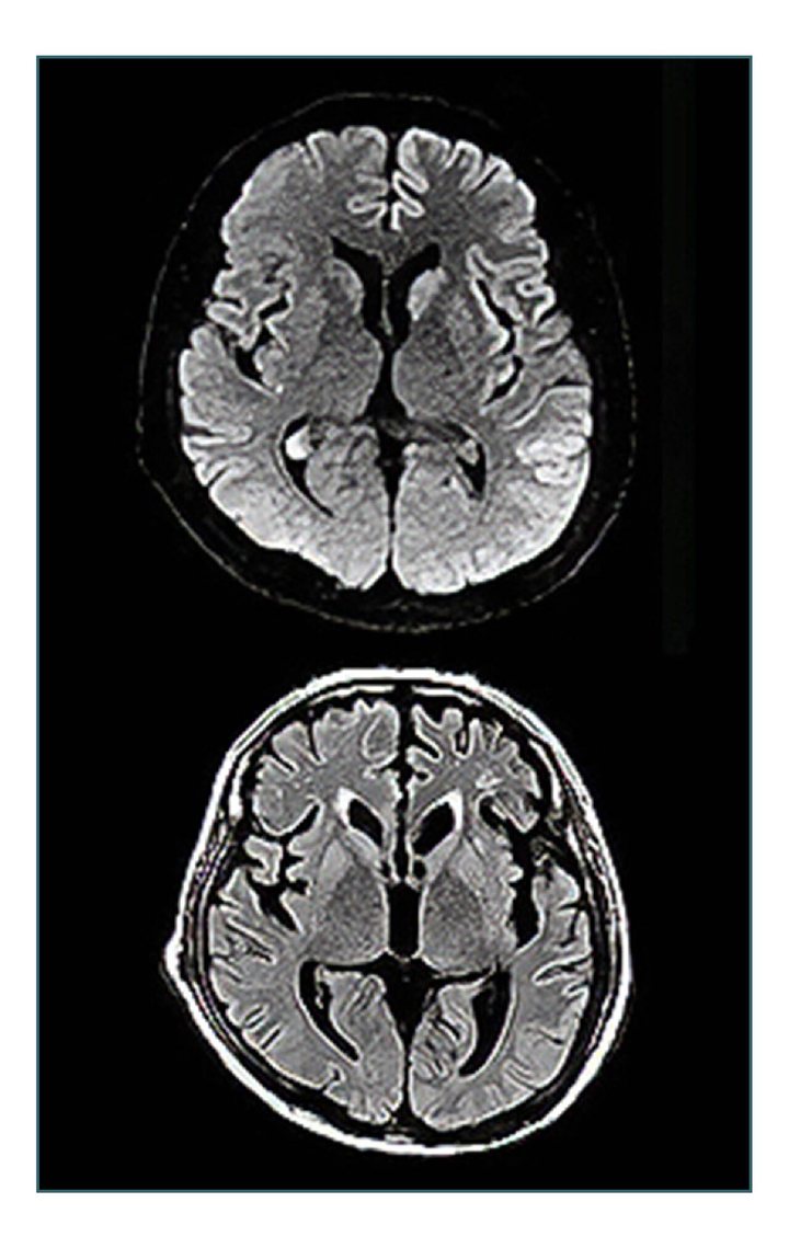 marrow_med's tweet photo. 50-year-old man with C/O forgetfulness, behavioural changes, &amp; visual hallucinations for the past 5mnths, unable to button his shirt &amp; tie his shoelaces as he had sudden jerky movements last 1mnth. His MRI &amp; EEG👇🏽. Mention MRI finding &amp; likely diagnosis? #MedTwitter #MedEd https://t.co/l3l4FdlAYN