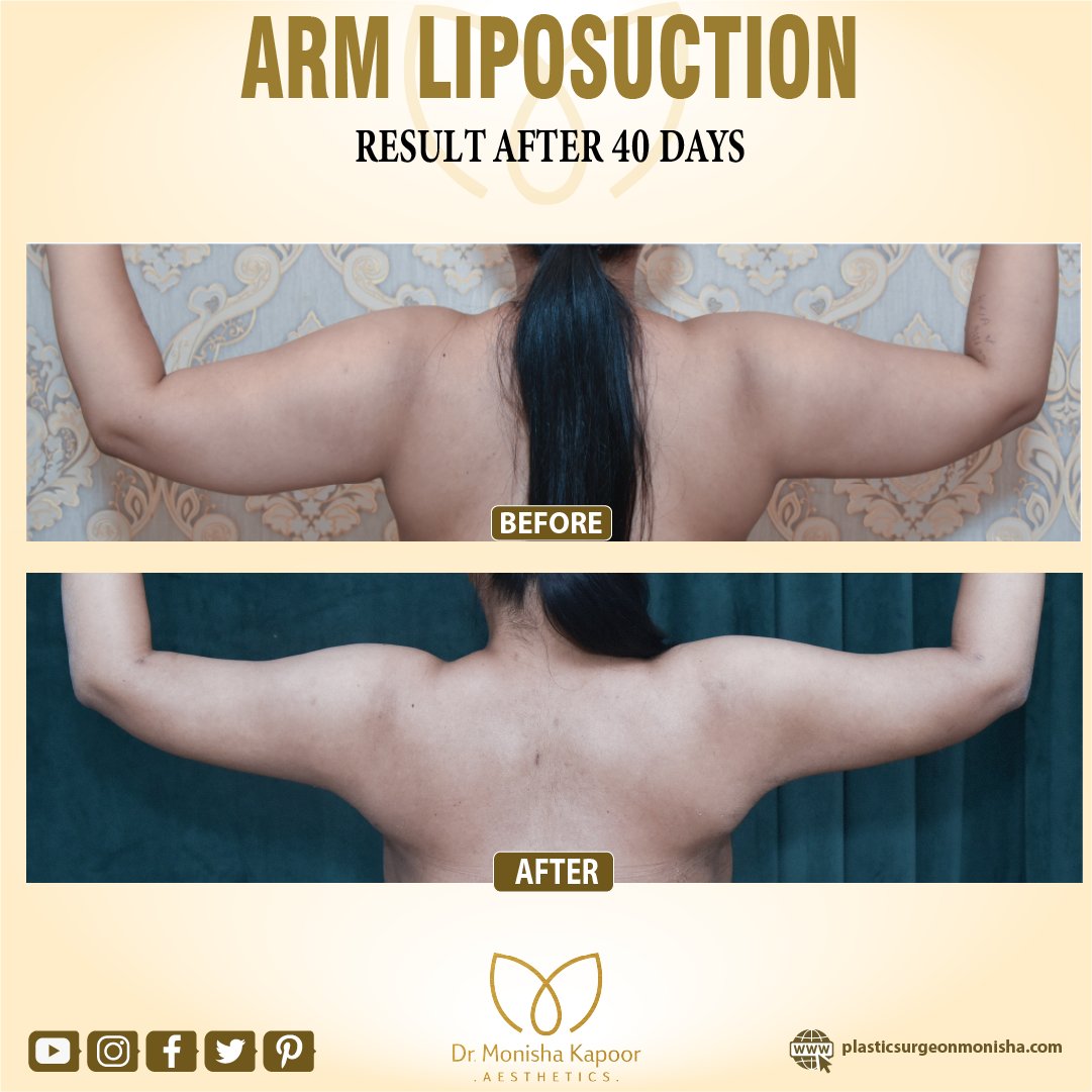 #armliposuction is performed to remove the loose, hanging skin that often develops on the underside of the upper arm as a result of weight loss, or weight gain.

Call us on +91- 8373984777, 8860851727