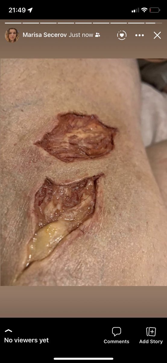 GrindhausFX's tweet photo. #prosthetics #gory #wound #abrasion #cut #gash #muscletissue #medicalsimulation #sfx #sfxmakeup #sfxmakeupartist #spfx #spfxmakeup #spfxmua #spfxmakeupartist #specialeffectsmakeup #specialeffects #specialeffectsmakeupartist #horror #halloween #halloweenmakeup #halloweensfxmakeup https://t.co/k2SH0kvNHB