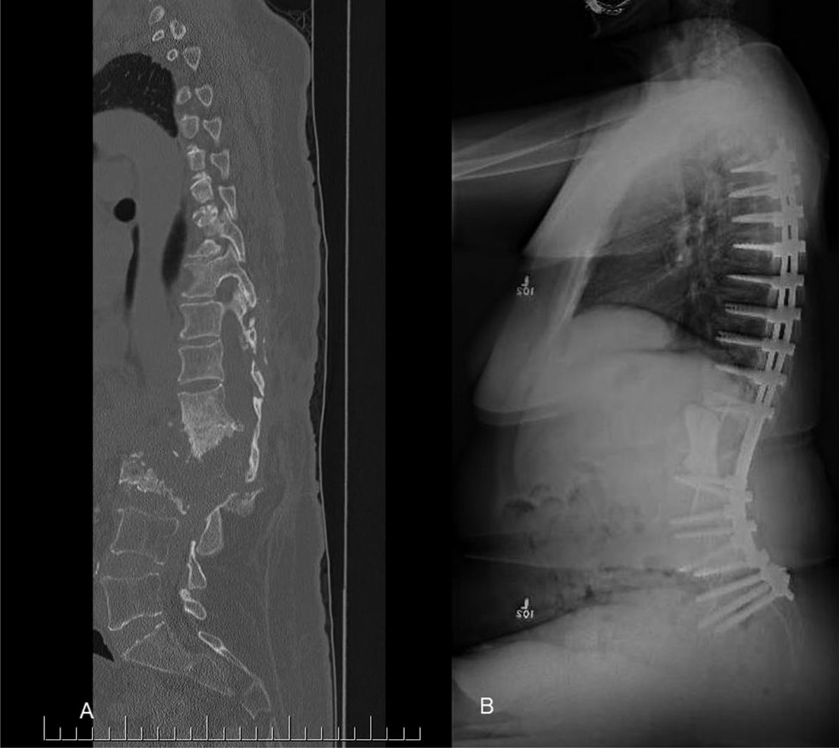 Review Charcot arthropathy of the spine with @mac_ortho HERE: bit.ly/3WGusRu #JAAOS #OrthoTwitter #Spine