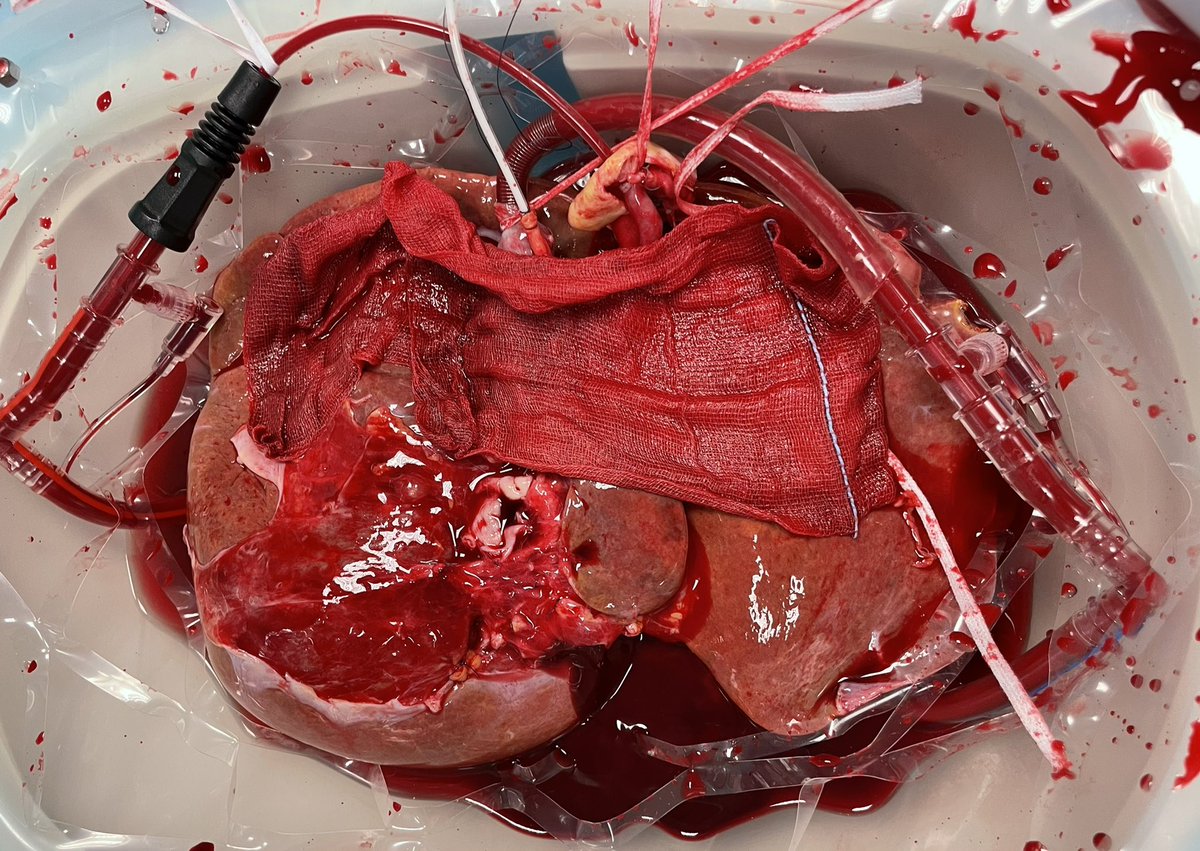 DeCarlis_R's tweet photo. Yesterday, we received a steatotic #liver reallocated to our transplant center after 11h of cold ischemia!
We tried a sequential approach with #HOPE first and subsequent #NMP for viability assessment and succesfully transplanted the liver in the night. #LiverTwitter #transplant https://t.co/EEIRe1BnTu