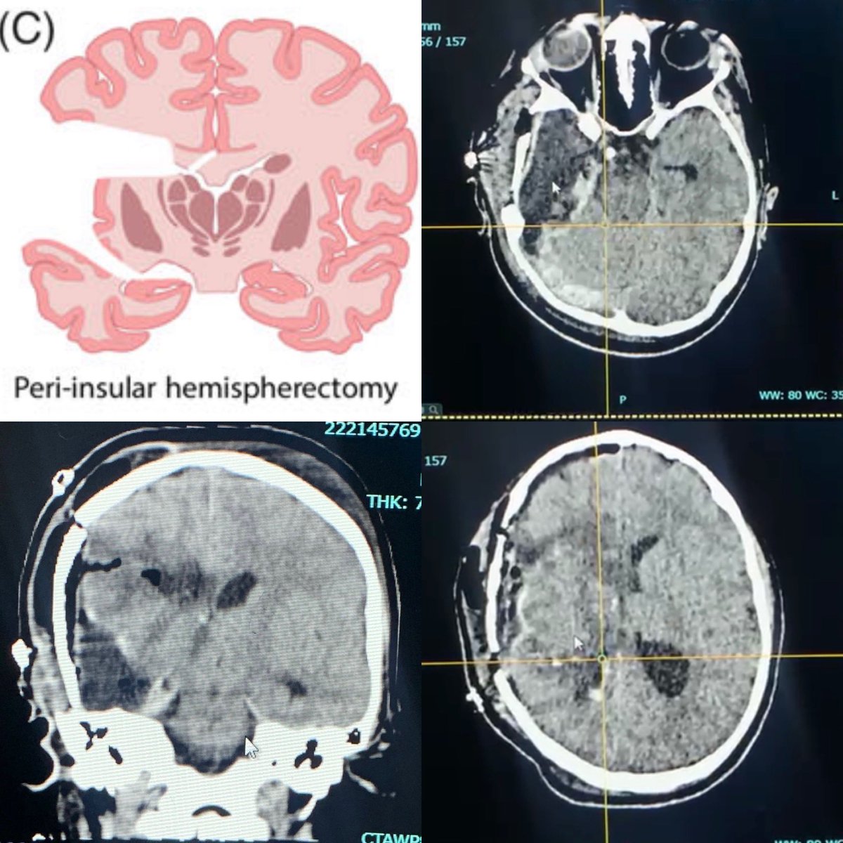 Peri-insular Hemispherectomy is a functional hemispherectomy with minimal brain removal for medical intractable epilepsy, our last week case #neurosurgery #epilepsy_surgery