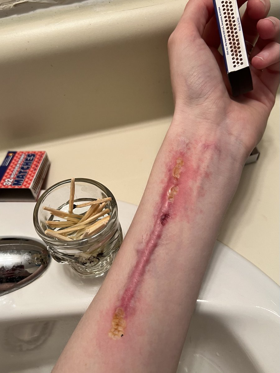 redblve's tweet photo. match stick burn makeup! fun but not as satisfying as doing a styro. there’s just something about blood isn’t there…

burntwt ouchietwt scartwt shtwt 988twt https://t.co/eN9o4ElPjl