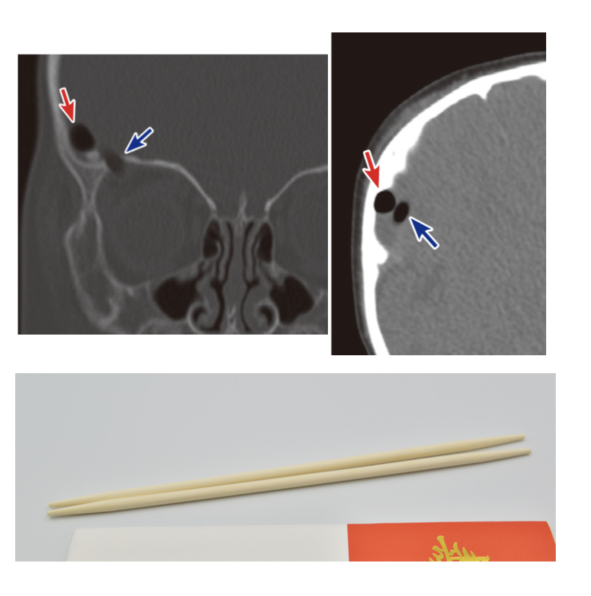 shubababan's tweet photo. @OGdukeneurosurg What is the material? I guess too white for plastic and not so white for metal.
↓Child who fell while holding disposable wood chopsticks https://t.co/ZDUb1qJaVc