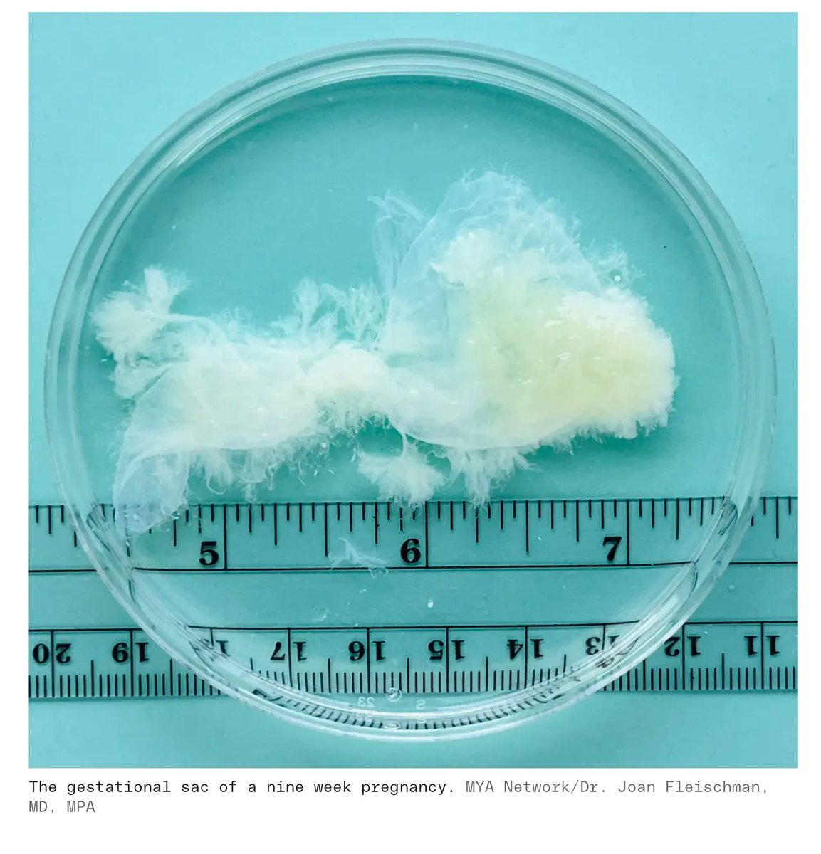 Most people don’t know what early #pregnancy actually looks like. 
That complicates #abortion discussions. 
buff.ly/3FL3u4W via <a href="/verge/">The Verge</a> 

#FactsMatter