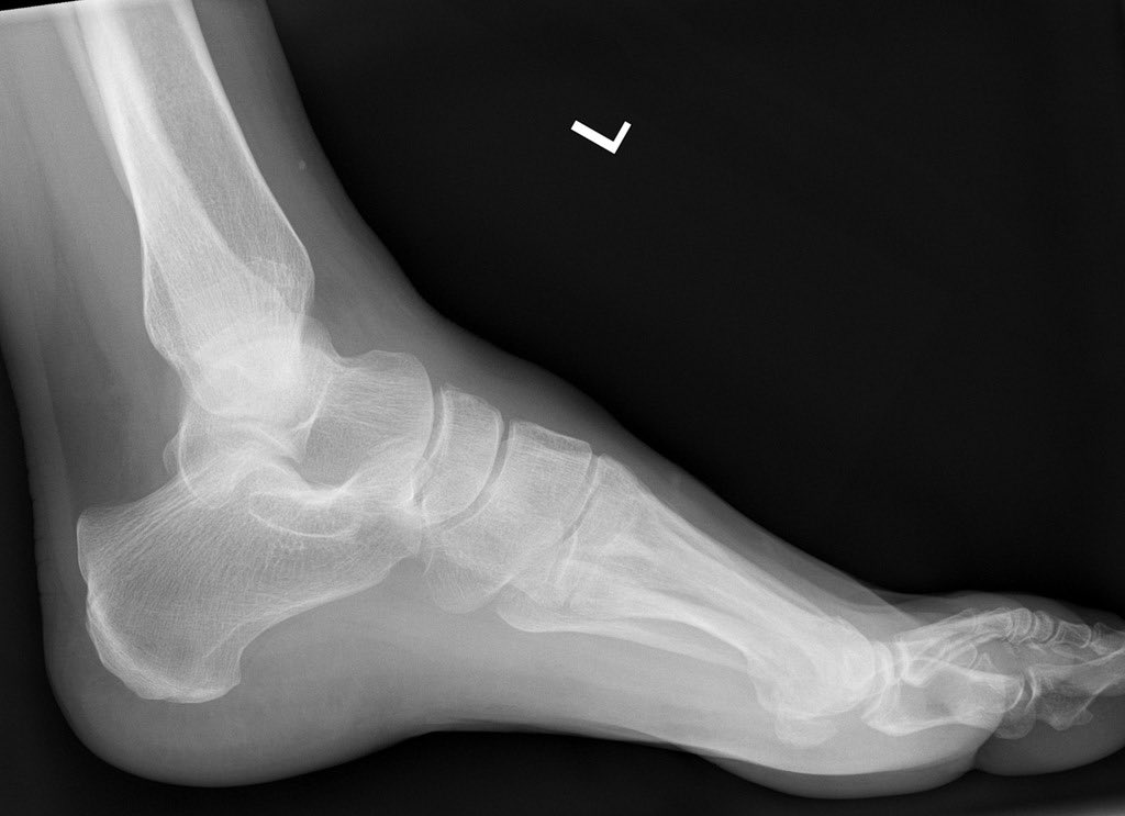 Radiopaedia's tweet photo. This 25yo woman tripped over a cat. The cat is presumably fine and smug as ever. Can you spot the injury? 

ANSWER: https://t.co/eKrPLvG4Yk

Case courtesy of @DrHenryK https://t.co/0fTMaXSQ4Y