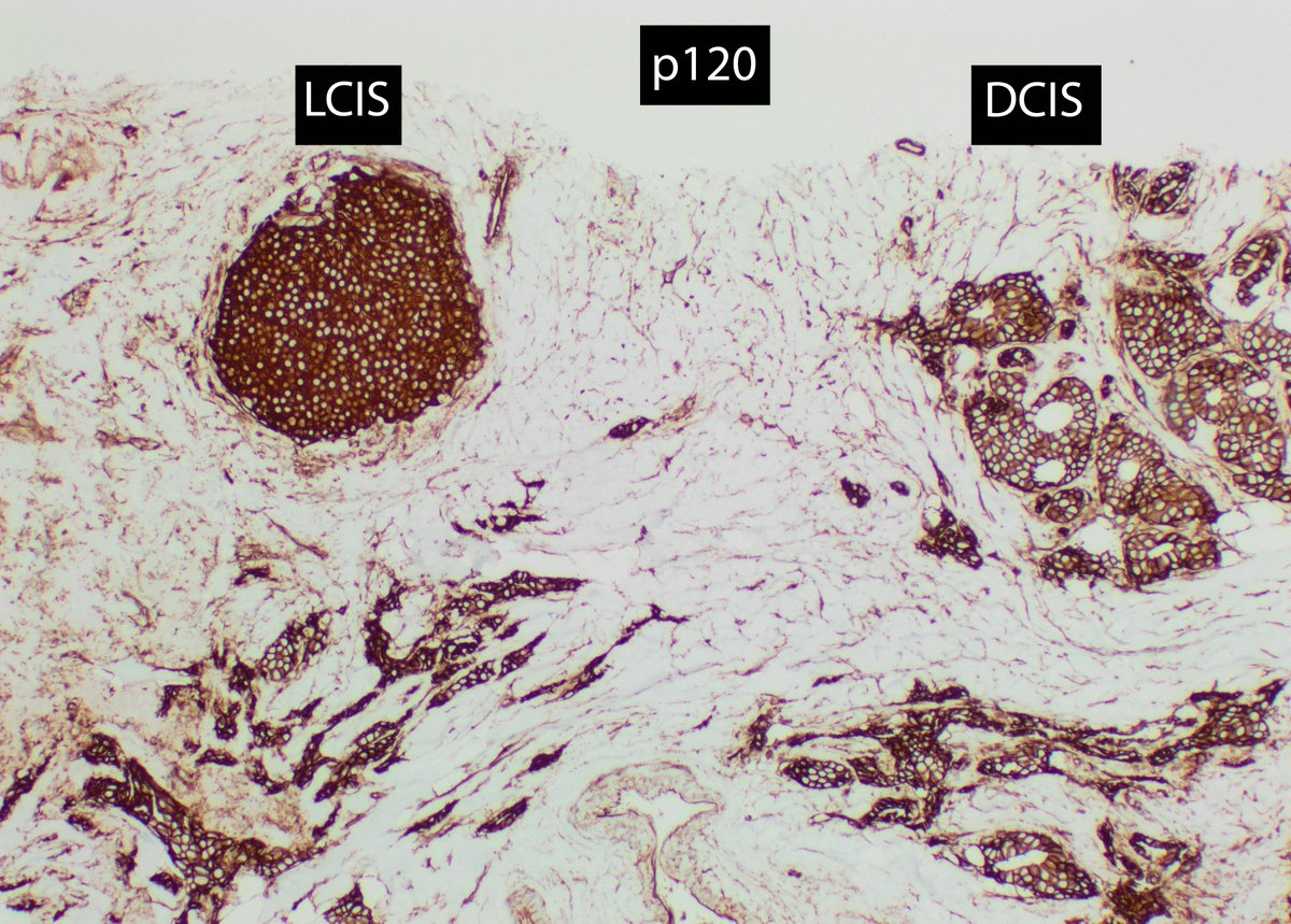 SamirAtiya1's tweet photo. Small foci of LCIS can be hard to see on H&amp;E. Here are IHCs of LCIS and DCIS in a breast core needle bx

p120: LCIS --> cytoplasmic vs DCIS --> membranous

E-cad: LCIS --> loss vs DCIS --> membranous

#breastpath #pathology #pathologists #womenshealth  #PathTwitter #MedTwitter https://t.co/o3yKGDwf2Y