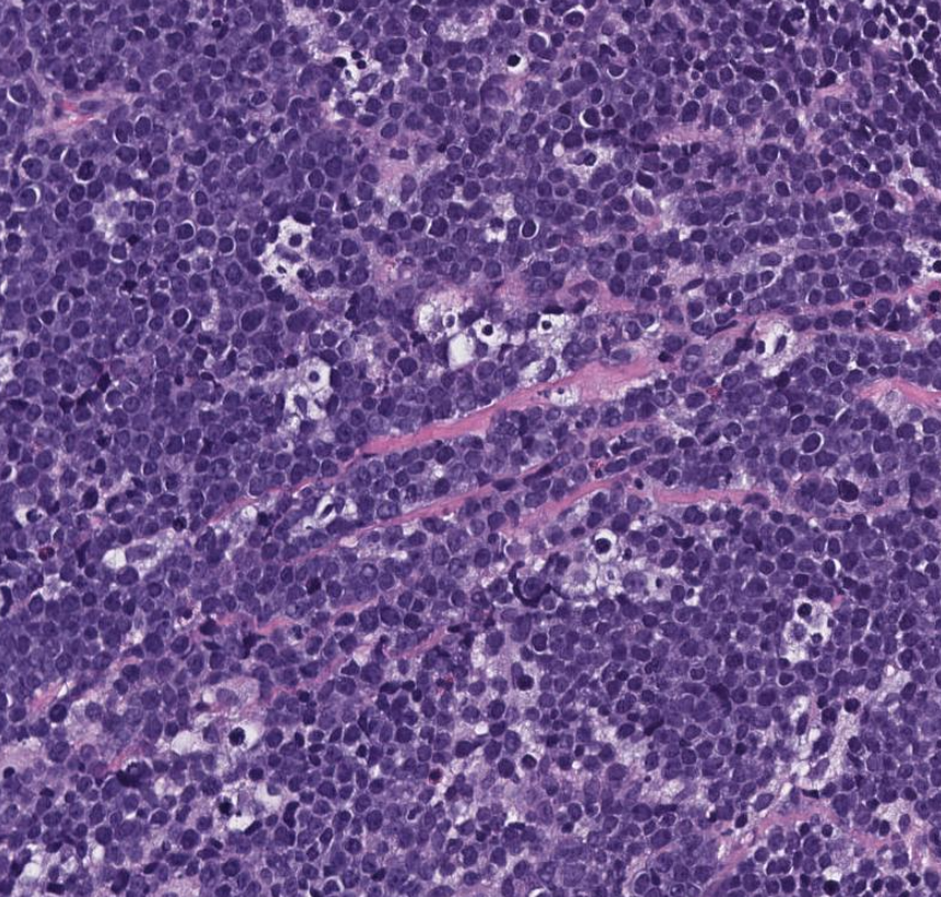SibaElHussein's tweet photo. Burkitt lymphoma, EBV+, HIV setting

Per 5th edition of the WHO, a three-part nomenclature is now recommended:
1) Name of lesion
2) virus status
3) Type of immunodeficiency

Navigate the slides: https://t.co/hKLI92Q3YR | Case 3

 #hemepath #lymsm #pathtwitter https://t.co/0wj3FgpKjS
