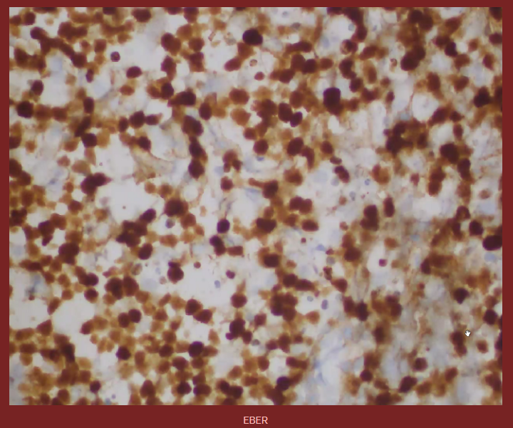 SibaElHussein's tweet photo. Burkitt lymphoma, EBV+, HIV setting

Per 5th edition of the WHO, a three-part nomenclature is now recommended:
1) Name of lesion
2) virus status
3) Type of immunodeficiency

Navigate the slides: https://t.co/hKLI92Q3YR | Case 3

 #hemepath #lymsm #pathtwitter https://t.co/0wj3FgpKjS