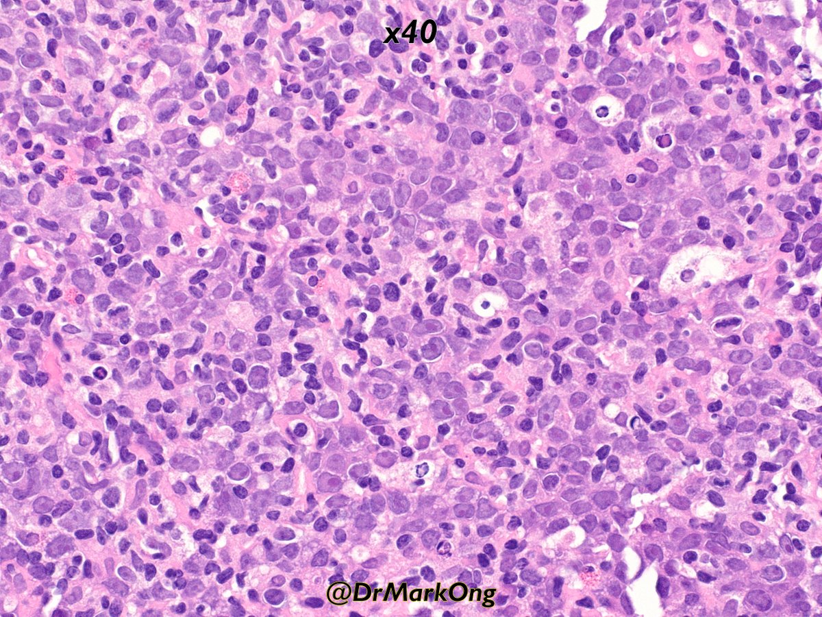 DrMarkOng's tweet photo. Neck lymph node core biopsy from an adult.

CD20+, CD79a+, BCL2 weak, CD10+ in <30%, BCL6+, MUM1+, Ki67 high (>90%).

Just a boring non-GC DLBCL?

Strictly speaking, you can only call it DLBCL after excluding double/triple hit lymphoma.

#hemepath https://t.co/58d0K245cN