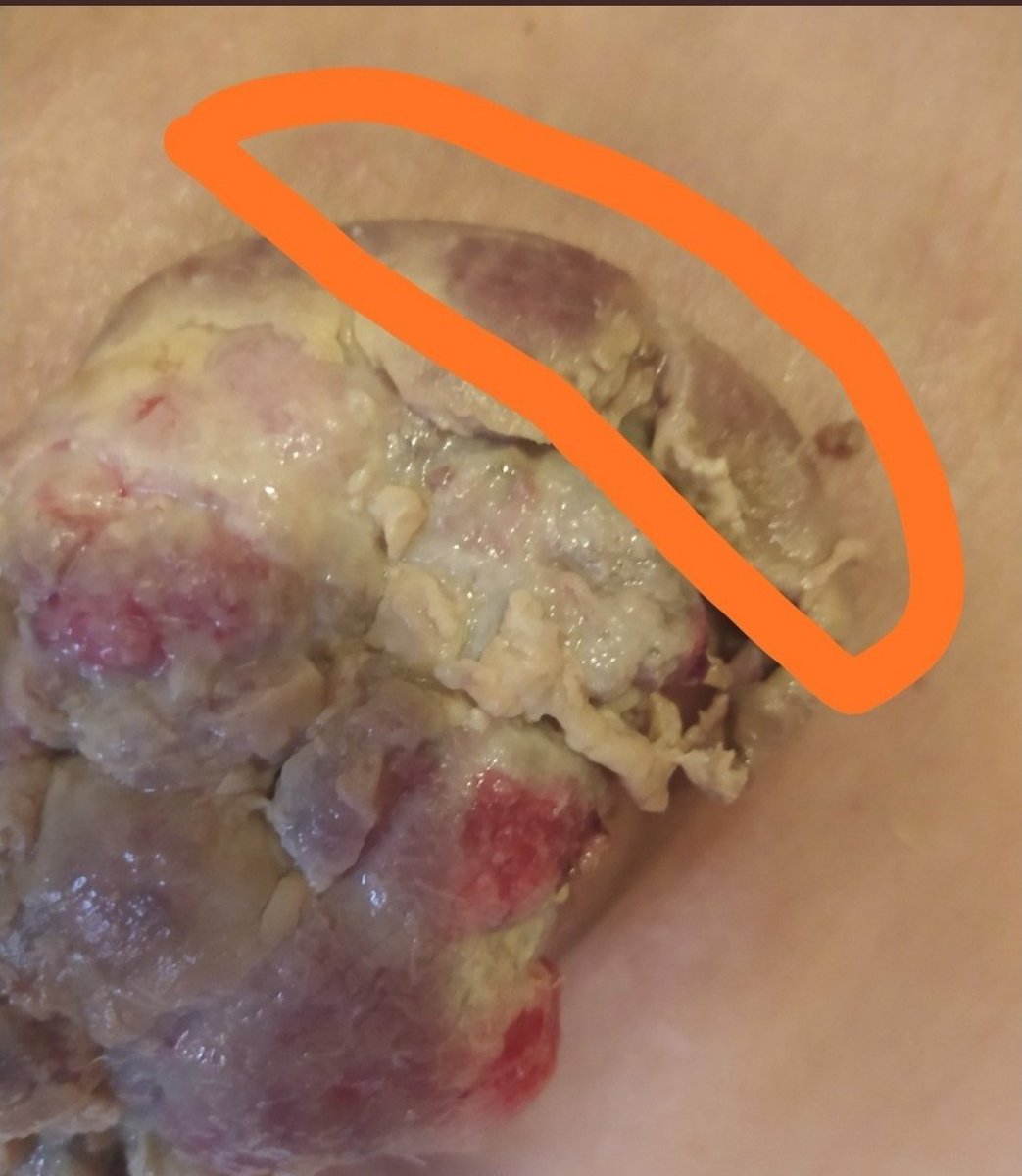 malufrancis's tweet image. URGENTE! 📢📢📢📢
Yari @decofiestasyari necesita de nuestra ayuda y de quienes puedan hacerlo. Va mejorando el tumor con la quimioterapia, la próxima es el día 8 de Noviembre. La meta son 350$.
Tratemos de hacer lo posible! Colaboremos con dinero, con dar RT! TODO VALE!!!💝