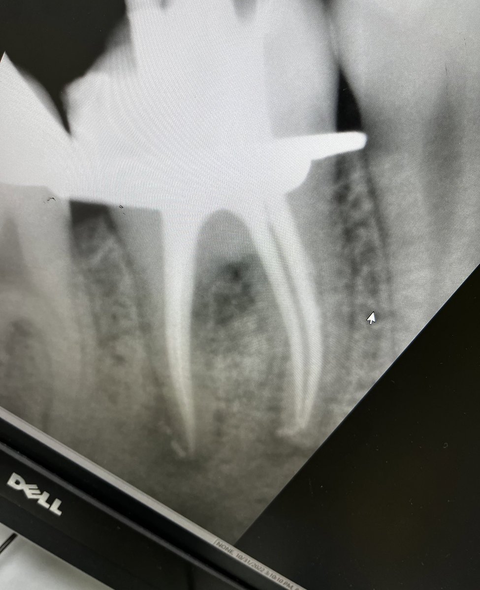 HindMM_'s tweet photo. My first RCT on a molar 🤍 https://t.co/XC52zZBem3