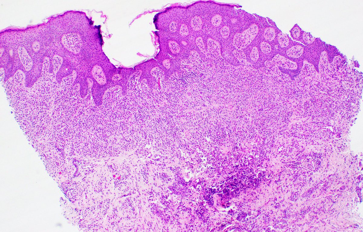 Case #4: this histologic beauty is very itchy. Whoooo 👻 can guess the diagnosis? 🎃 #pathology #pathtwitter #dermpath