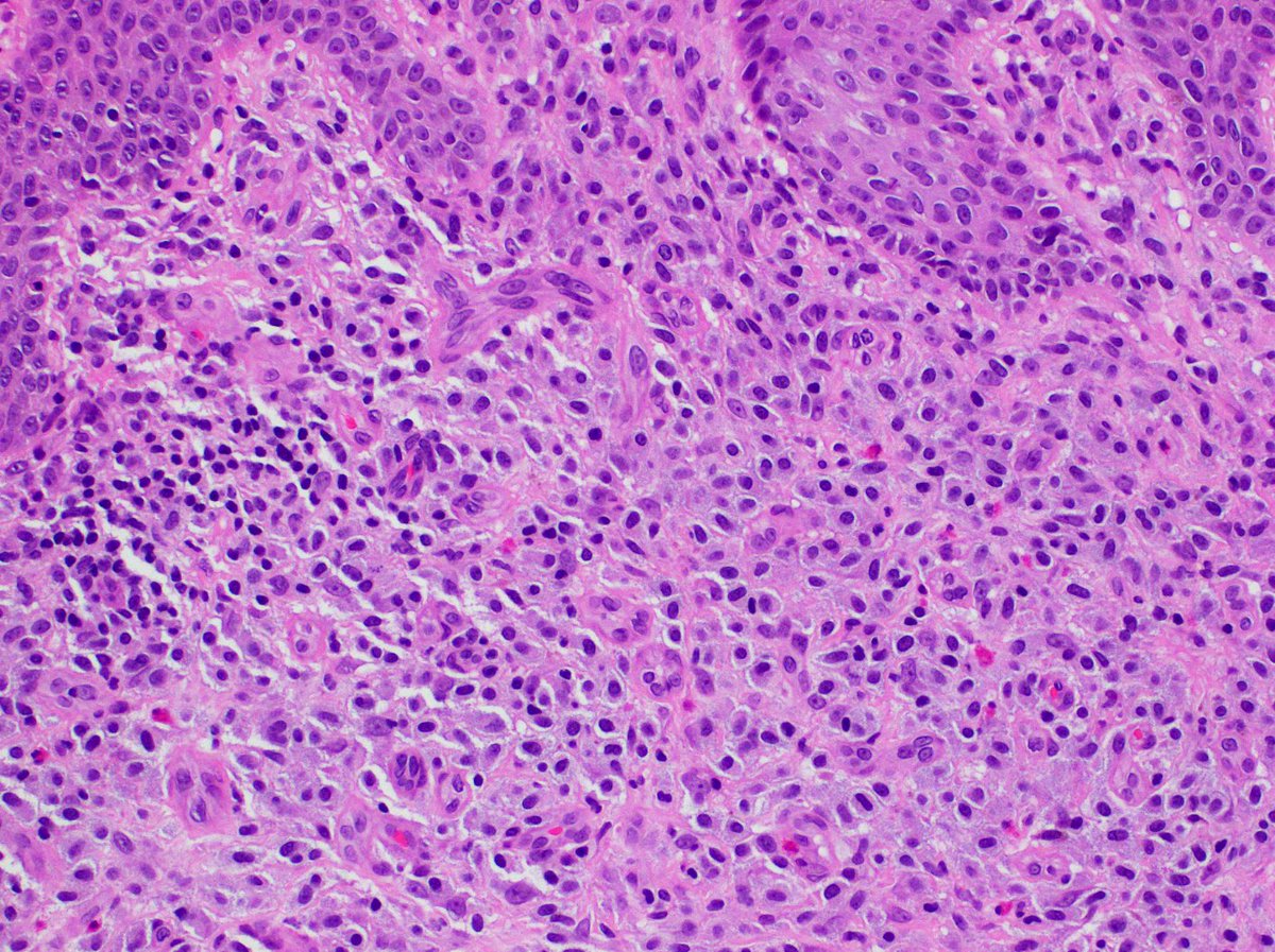 PathAlbanyMed's tweet photo. Case #4: this histologic beauty is very itchy. Whoooo 👻 can guess the diagnosis? 🎃 #pathology #pathtwitter #dermpath https://t.co/zTbIbmkQQs