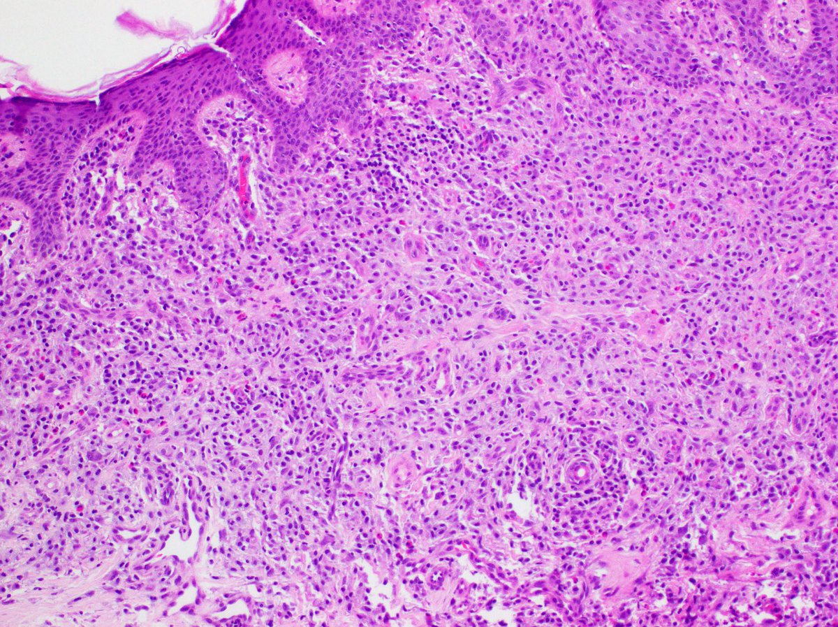 PathAlbanyMed's tweet photo. Case #4: this histologic beauty is very itchy. Whoooo 👻 can guess the diagnosis? 🎃 #pathology #pathtwitter #dermpath https://t.co/zTbIbmkQQs