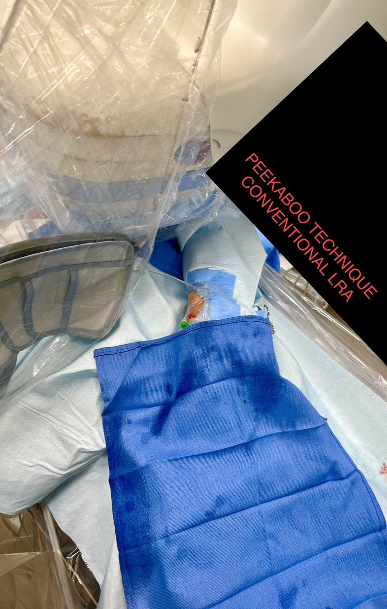 Tesslagra's tweet image. Little #cathlabhack for caudal views from LRA approach. 
Tuck the lead skirt just over the hub of the sheath. This will limit scatter☢️ to the 🤚 &amp;amp; still provide great protection to the upper body with ceiling mounted shield. Done with peekaboo technique preserving ergonomics