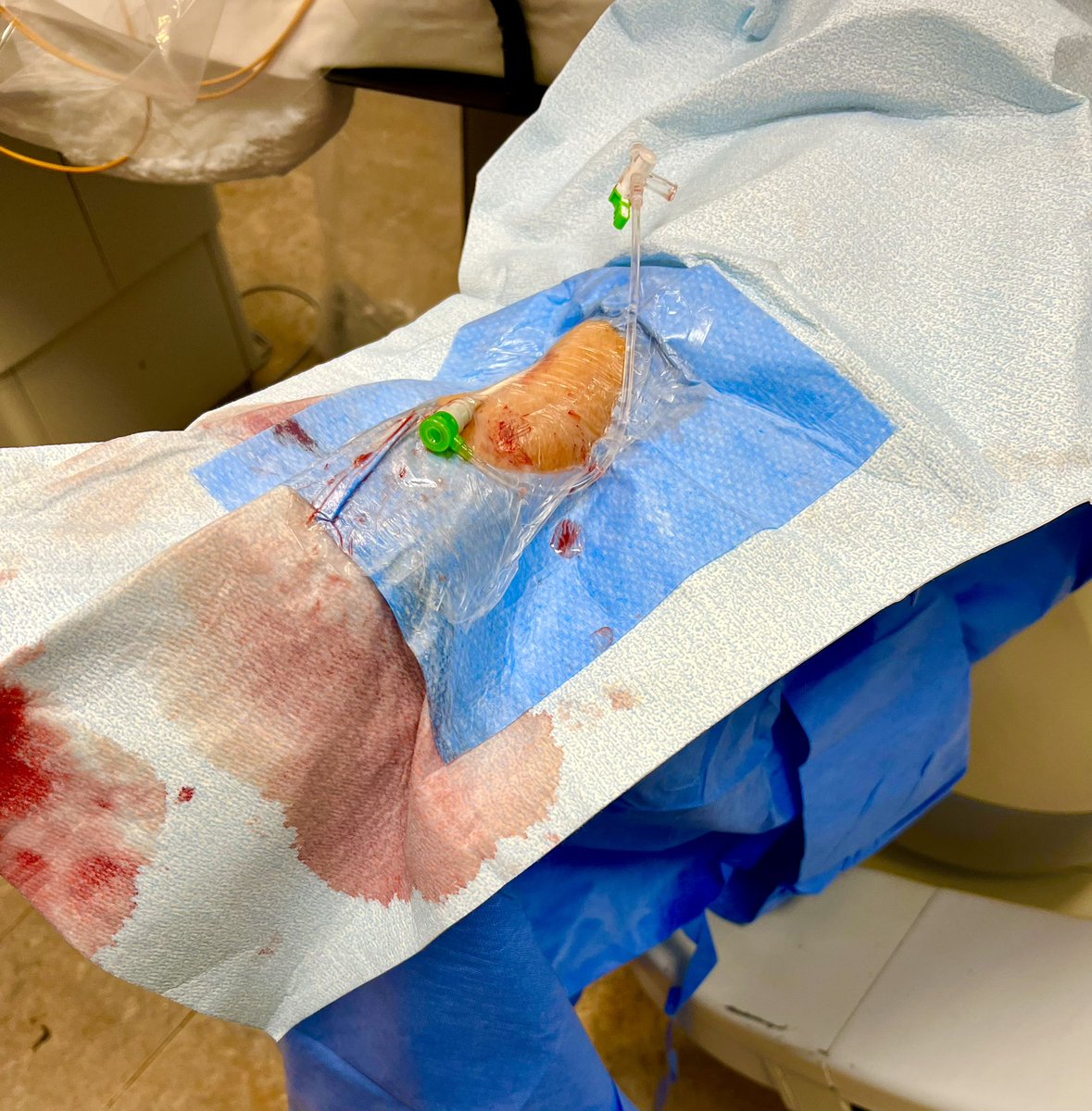 Tesslagra's tweet image. Little #cathlabhack for caudal views from LRA approach. 
Tuck the lead skirt just over the hub of the sheath. This will limit scatter☢️ to the 🤚 &amp;amp; still provide great protection to the upper body with ceiling mounted shield. Done with peekaboo technique preserving ergonomics